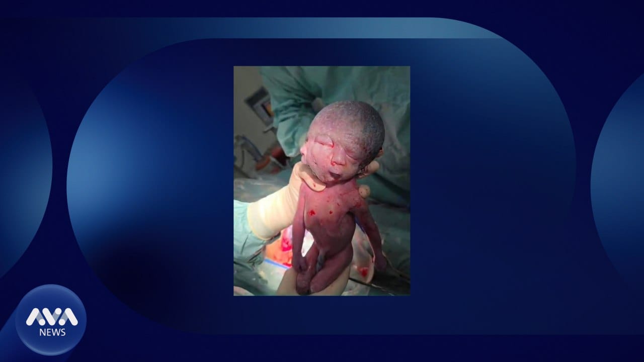 ئەو منداڵەی بە دوو ڕووخسار لەدایک بوو گیانی لەدەست دا