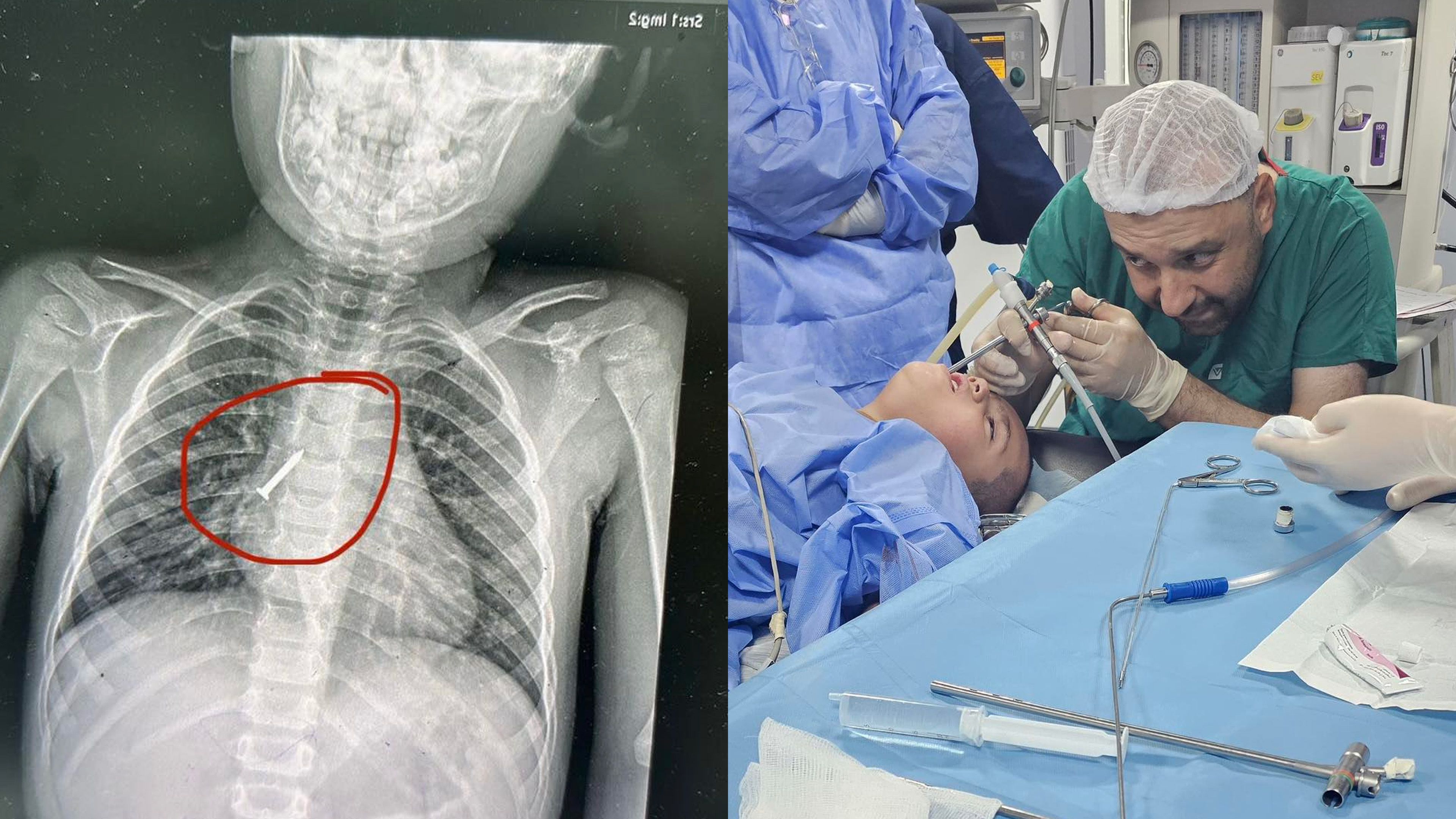 بزمارێك لە بۆری هەناسەی منداڵێك بەسەركەوتوویی دەردەهێنرێت