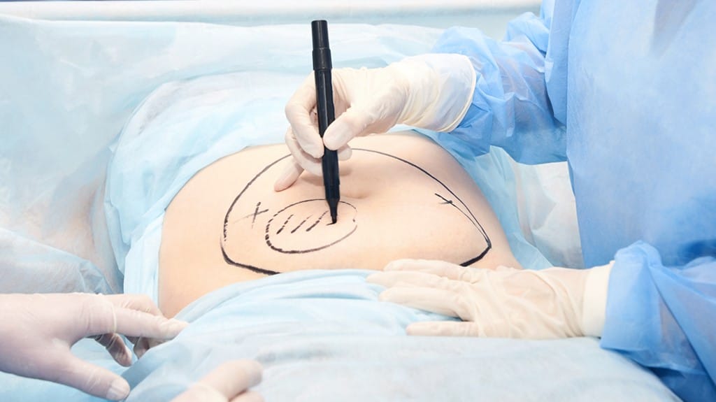 هۆشداری لە نەشتەرگەریی بچووککردنەوەی گەدە دەدرێت