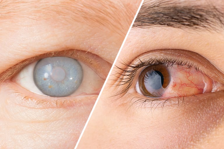 توێژینەوەیەک: بەرزبوونەوەی فشاری خوێن یەکێک لە هۆکارەکانی دروستبوونی ئاوی سپی چاوە