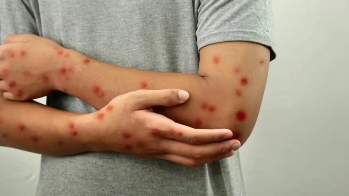 یەکەم تووشبووی ئاوڵەی مەیمون لە مەغریب تۆمارکرا