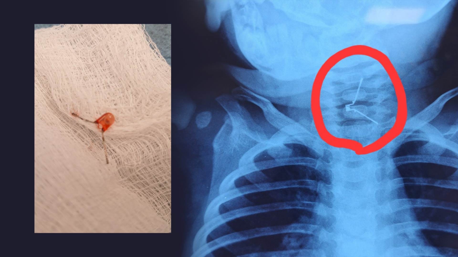 لە دهۆک منداڵێکی یەک ساڵ گڵۆپێک قووت دەدات و نەشتەرگەرییەکی دەگمەنی بۆ دەکرێت