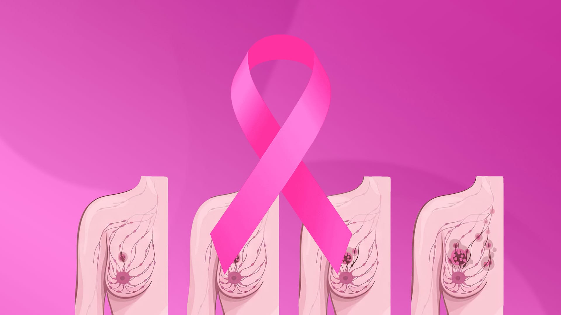 وەزارەتی تەندروستی لەبارەی شێرپەنجەی مەمک هۆشداریی دەداتە خانمان